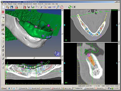 Implant Planning Software

